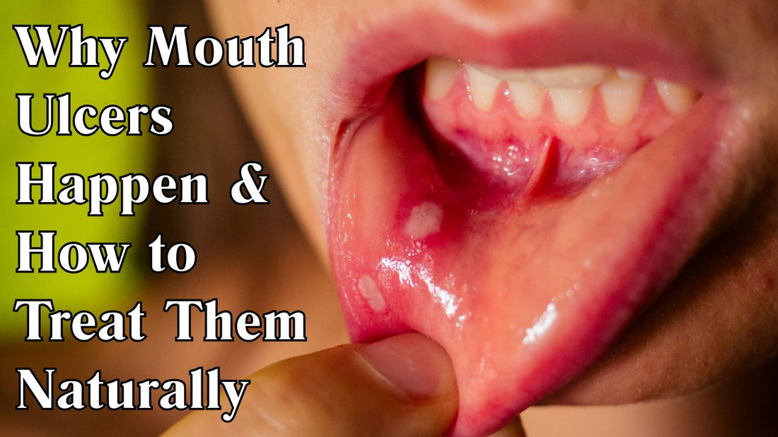 Why Mouth Ulcers Happen & How to Treat Them Naturally ?