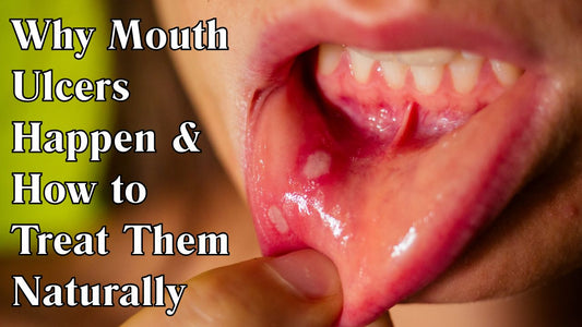 Why Mouth Ulcers Happen & How to Treat Them Naturally ?