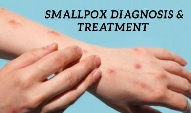 Smallpox Diagnosis & Treatment