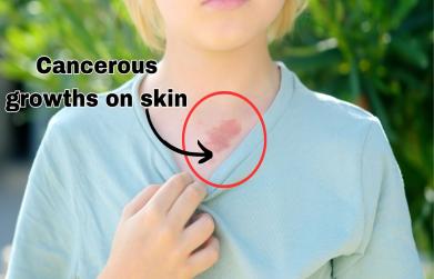 Cancerous growths on skin
