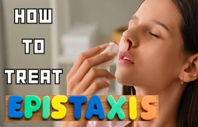 how to treat epistaxis