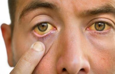 How to Treat Jaundice in Adults