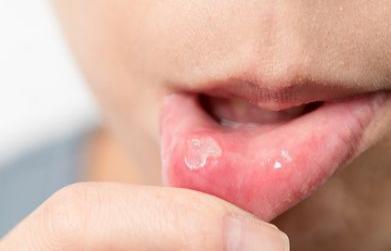 How to cure mouth ulcers fast naturally